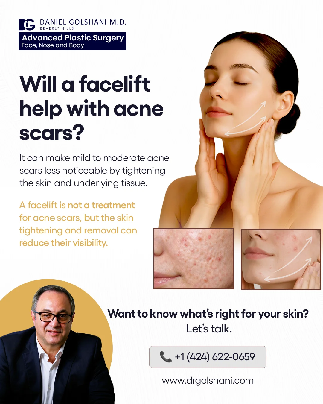 Facelift and Acne Scars Post
